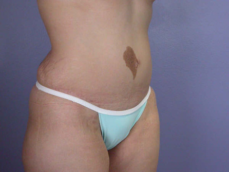 Liposuction before and after photo