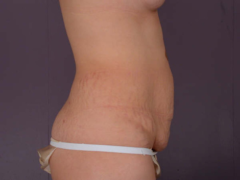 Liposuction before and after photo