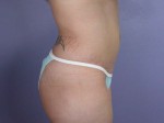 Liposuction Before and after photo