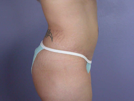 Liposuction before and after photo