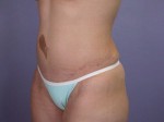 Liposuction Before and after photo