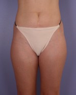 Liposuction