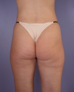 Liposuction