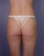 Liposuction