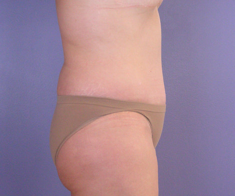 Liposuction before and after photo