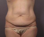 Liposuction