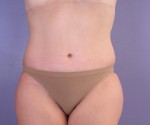 Liposuction Before and after photo