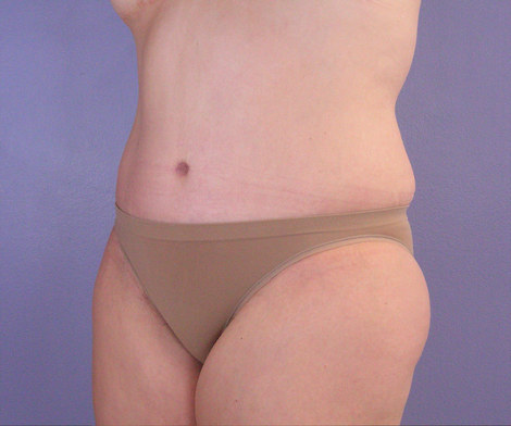 Liposuction before and after photo