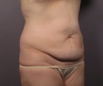 Liposuction Before and after photo