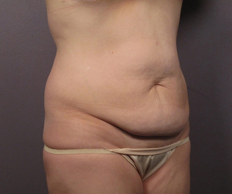 Liposuction before and after photo