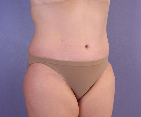 Liposuction before and after photo