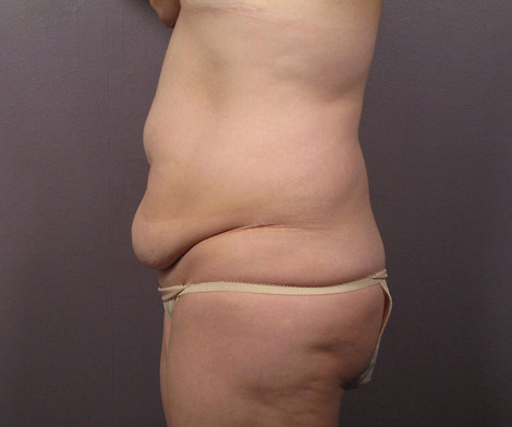 Liposuction before and after photo