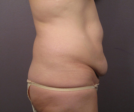 Liposuction before and after photo