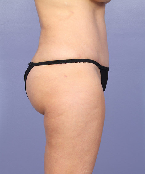 Liposuction before and after photo