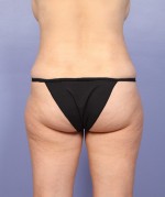 Liposuction Before and after photo