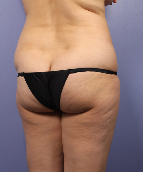 Liposuction before and after photo