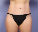 Liposuction Before and after photo