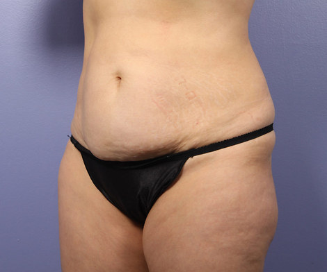 Liposuction before and after photo