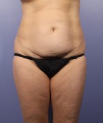 Liposuction Before and after photo