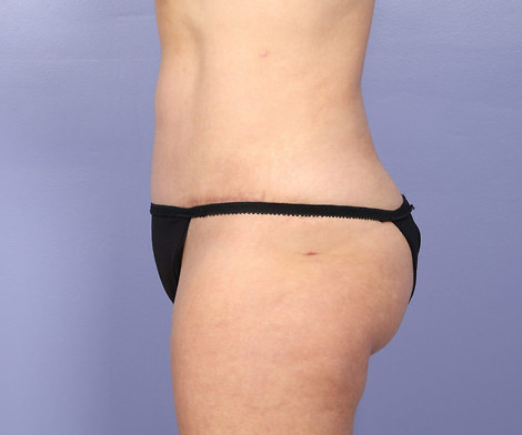 Liposuction before and after photo