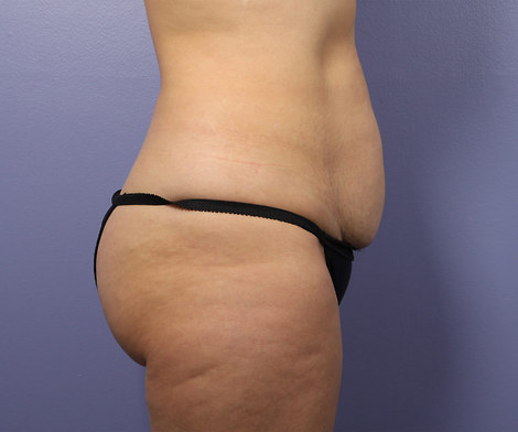 Liposuction before and after photo