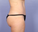 Liposuction Before and after photo