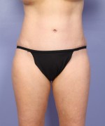 Liposuction Before and after photo