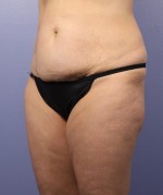 Liposuction Before and after photo