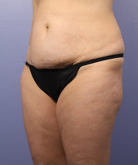 Liposuction before and after photo