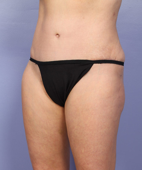 Liposuction before and after photo