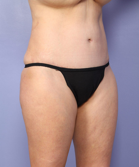 Liposuction before and after photo