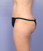 Liposuction Before and after photo