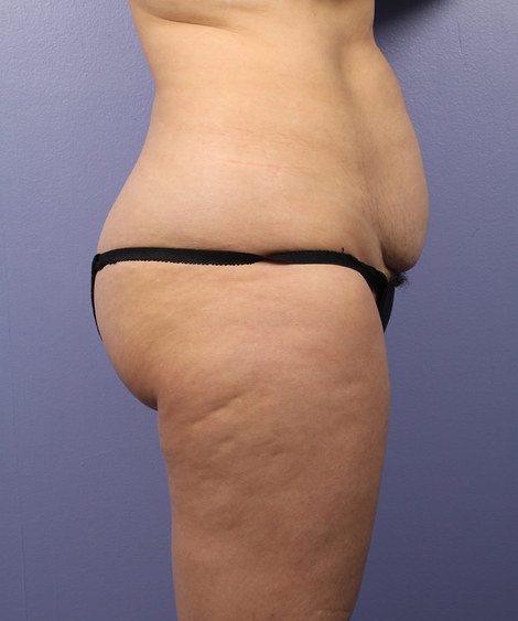 Liposuction before and after photo