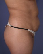 Liposuction Before and after photo