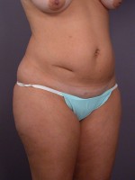 Liposuction