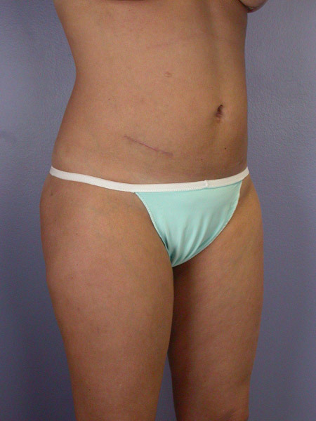 Liposuction before and after photo