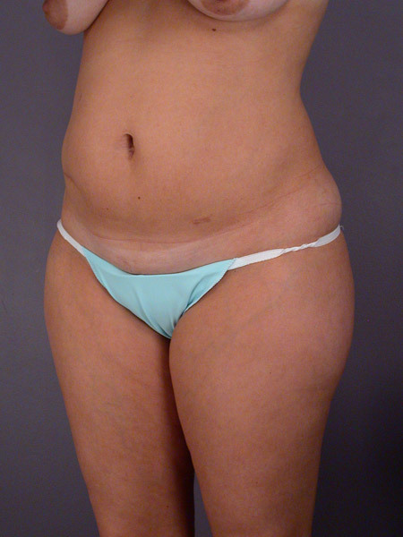 Liposuction before and after photo