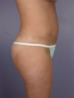 Liposuction Before and after photo