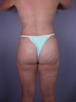 Liposuction Before and after photo