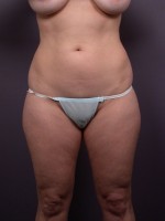 Liposuction