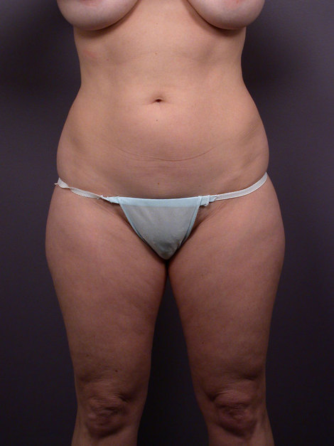 Liposuction before and after photo