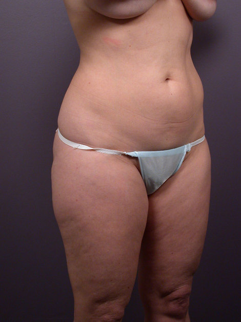 Liposuction before and after photo