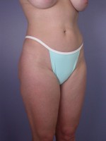 Liposuction