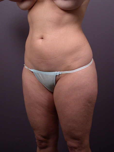 Liposuction before and after photo