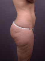 Liposuction Before and after photo
