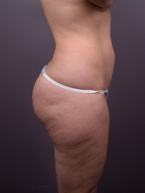 Liposuction before and after photo