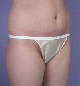 Liposuction before and after photo
