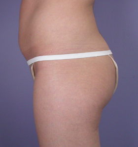 Liposuction before and after photo