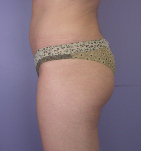 Liposuction before and after photo