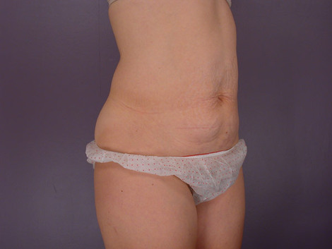 Liposuction before and after photo